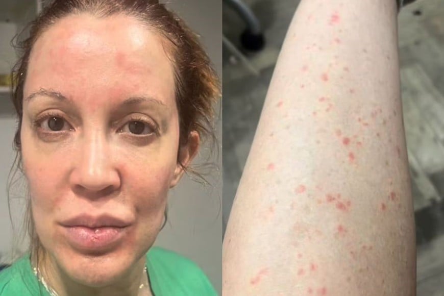 Miriam Lanzoni contó que tuvo una fuerte psoriasis.