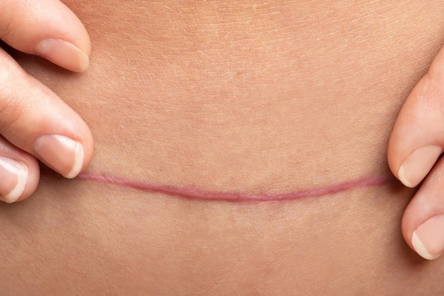 La combinación de alta proporción de cesáreas y fuerte participación del sector público configura un escenario exigente para el sistema de salud