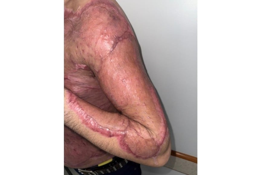 La recuperación del brazo del paciente quemado