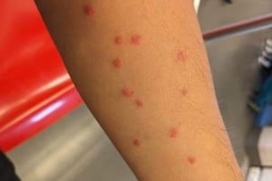 El jején, borrachudo o mosca negra provoca una lesión diferente a la del mosquito.
