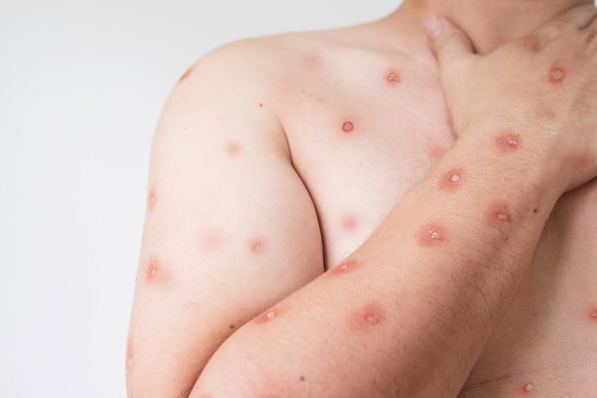 Desde el 2024 se detectaron casos asociados a viajes en Europa, Asia y América, incluyendo Estados Unidos, Canadá y Brasil.