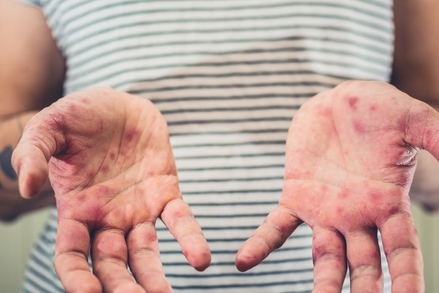 Resurgimiento del sarampión en América del Norte