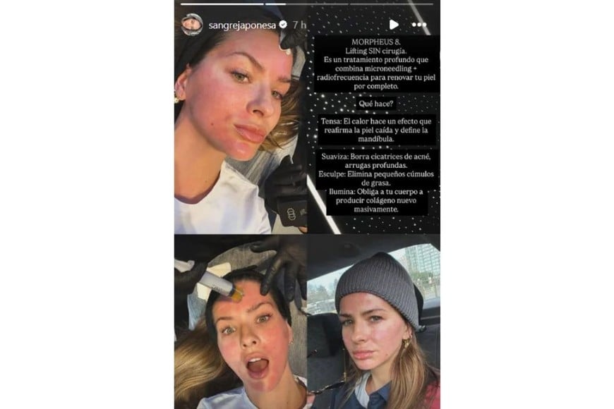 Morpheus 8, radiofrecuencia y agujitas: el “lifting” que la China Suárez mostró paso a paso.