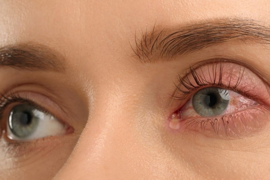 La conjuntiva es el tejido transparente que recubre la parte blanca del ojo y el interior de los párpados.