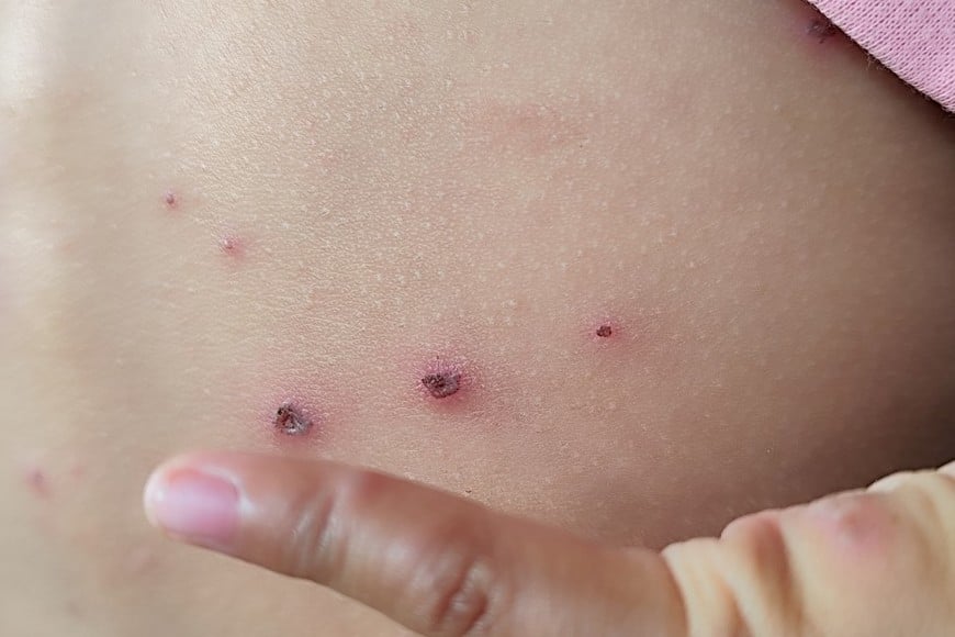 El caso fue confirmado a través del Sistema Nacional de Vigilancia de la Salud (SNVS 2.0).