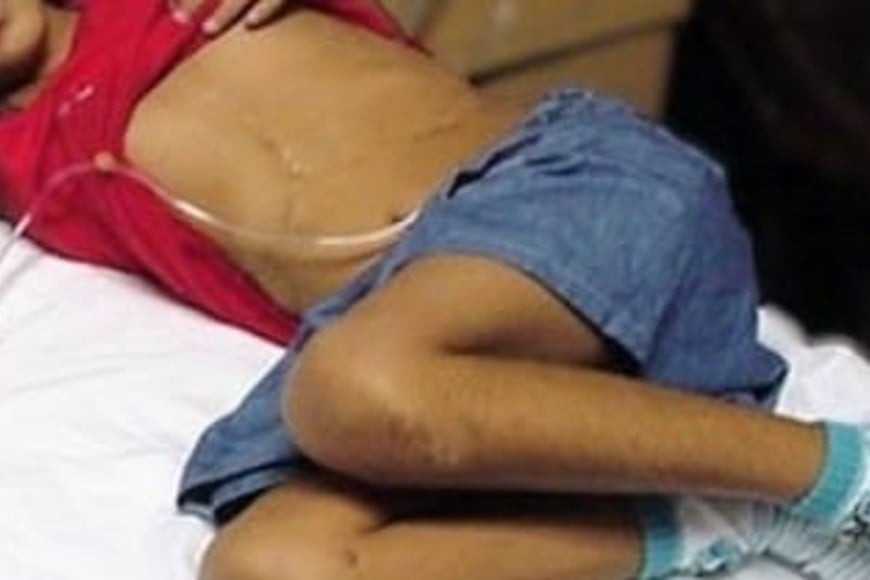 Niña de 7 años con enfermedad muy grave. A los 5 años sufrió hepatitis A fulminante y recibió trasplante de hígado. Una vacuna del calendario nacional evita esto.