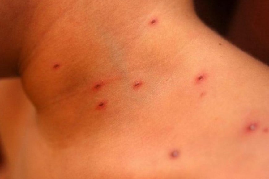 Especialistas advierten que la disminución en la aplicación de la vacuna triple viral generó bolsones de población susceptible al sarampión.