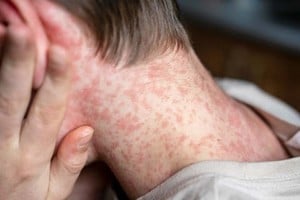 El sarampión puede provocar complicaciones graves, especialmente en niños pequeños.