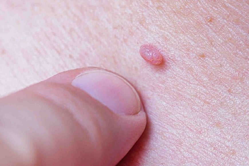 Los hombres no solo pueden portar y transmitir el virus, sino que también enfrentan riesgos concretos de desarrollar enfermedades graves,