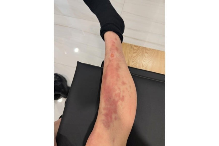 La vocalista de  The Pretty Reckless fue picada por una araña venenosa en México.