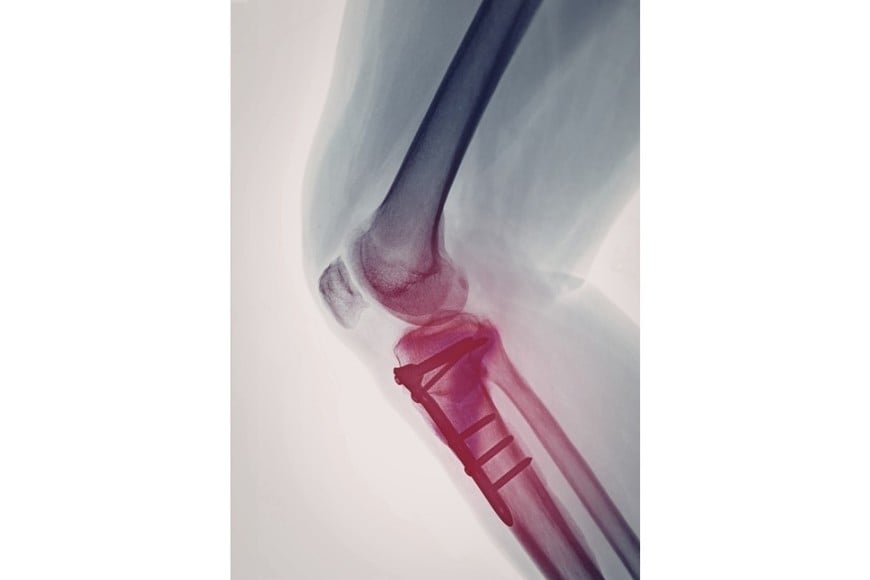 Un tornillo quirúrgico falsificado y otros implantes de origen desconocido