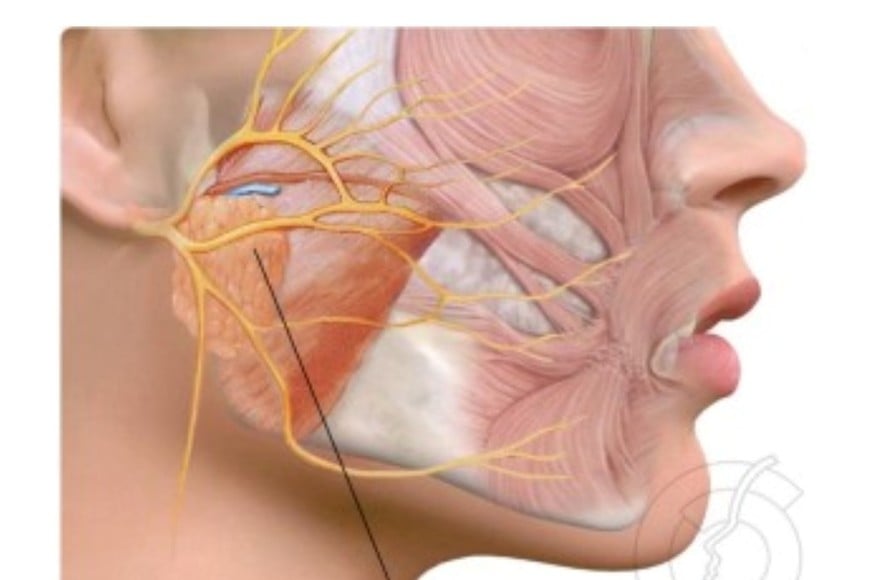 Cistoadenoma parotídeo bilateral: claves de la enfermedad y cómo es la cirugía de remoción