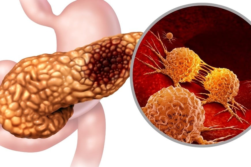 Un medicamento experimental mostró resultados alentadores en pacientes con cáncer de páncreas