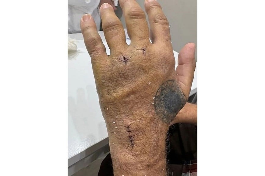 Malosetti sufrió una grave lesión en la mano.