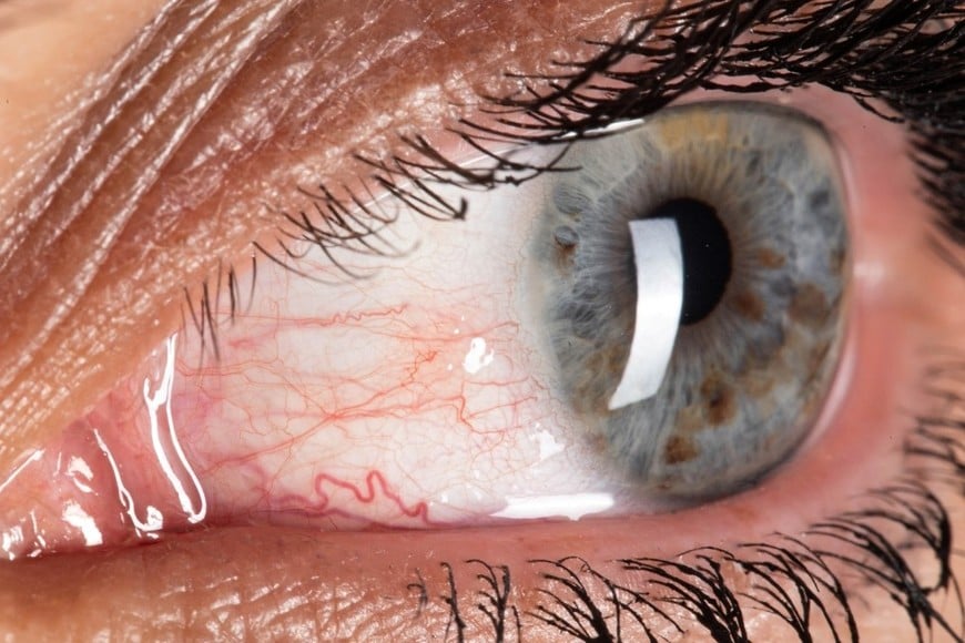 La superficie ocular depende de una delicada capa de lágrimas compuesta por agua, mucina y lípidos.