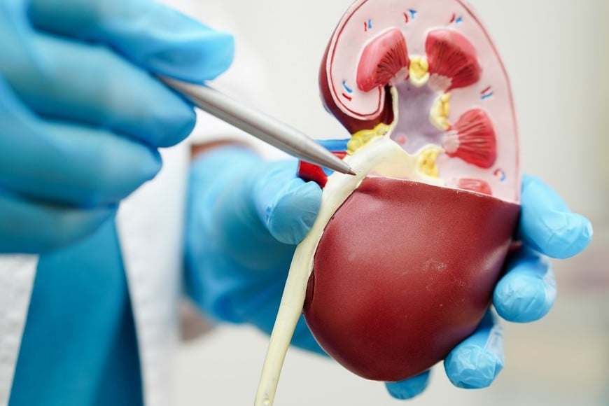 El principal desafío del cáncer renal es que, en sus primeras etapas, rara vez produce síntomas