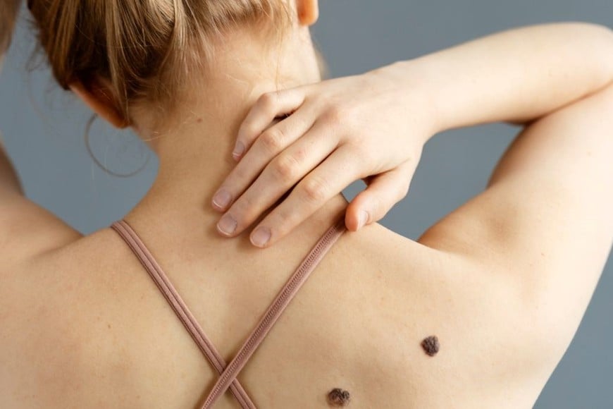 El melanoma es uno de los tipos de cáncer de piel más agresivos y requiere un diagnóstico precoz.