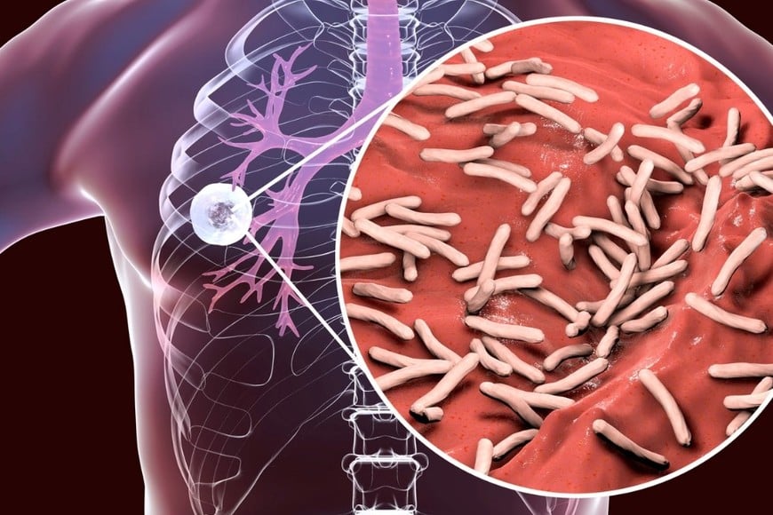 Es una infección bacteriana que sigue circulando en la comunidad
