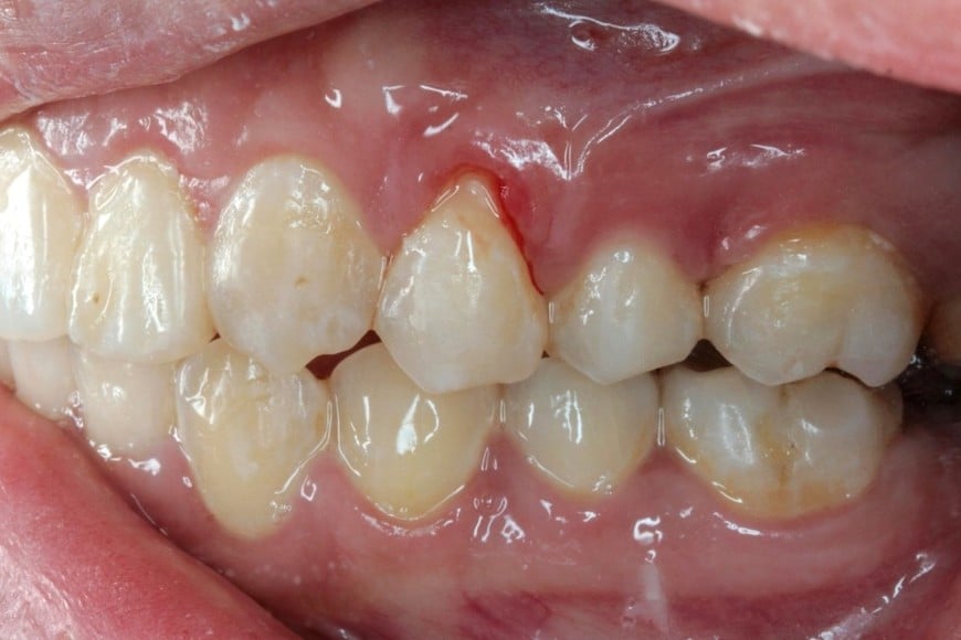 Encontrar unas gotas de sangre en el cepillo de dientes puede parecer un problema menor.