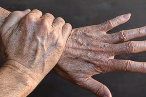 Las manchas en las manos pueden tener múltiples causas