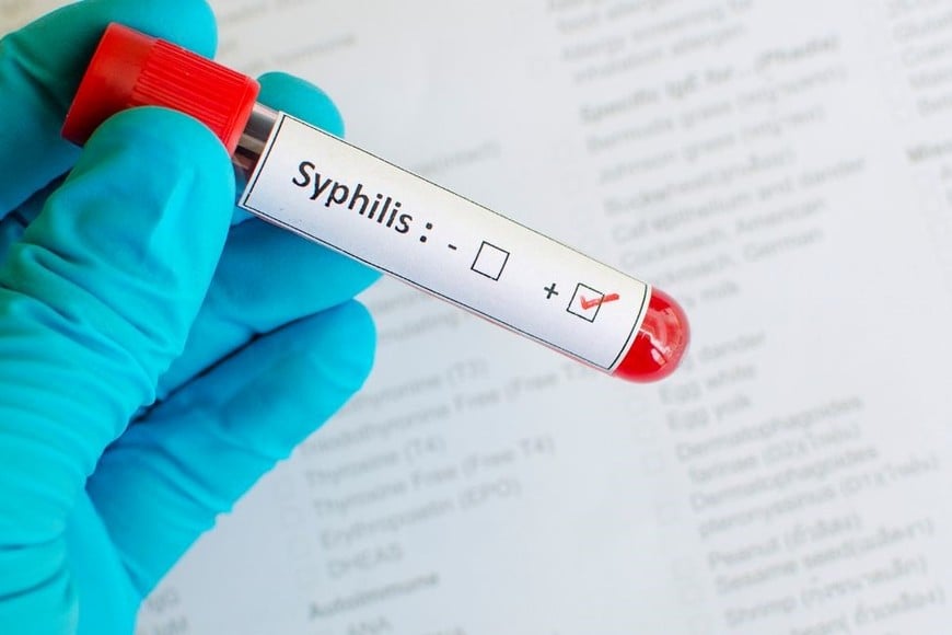 Sífilis: 33.495 casos acumulados