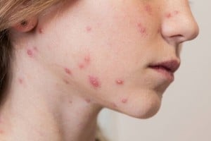 Conocer los síntomas iniciales y fases de contagio para prevenir