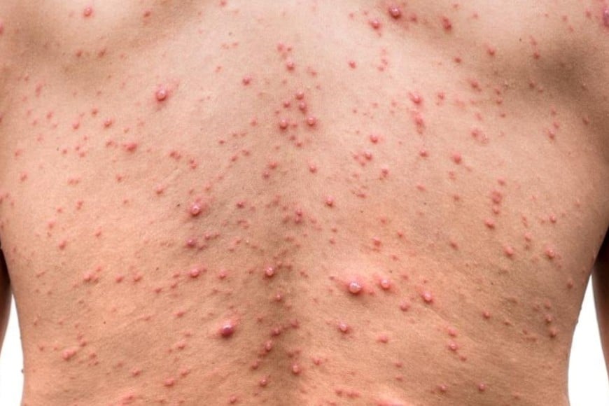 Seguimiento epidemiológico y período de incubación