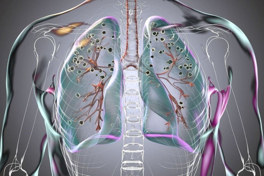 En una proporción menor de casos, pueden corresponder a un tumor maligno.
