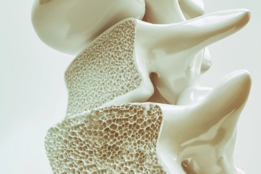 La osteoporosis es una enfermedad en la que disminuye la densidad mineral de los huesos
