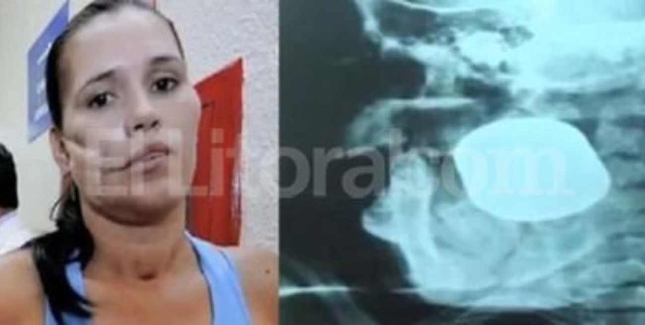 Le extirparon de la cara una granada sin explotar