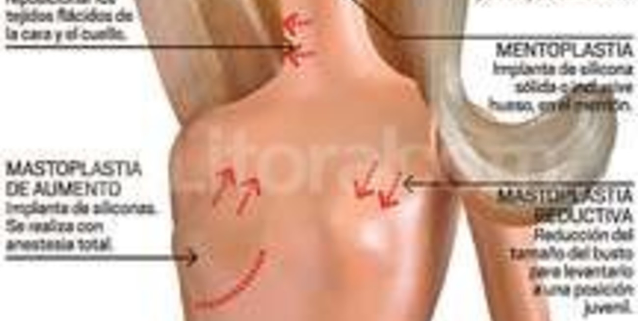 "Lolas" y liposucción, las cirugías preferidas por los santafesinos