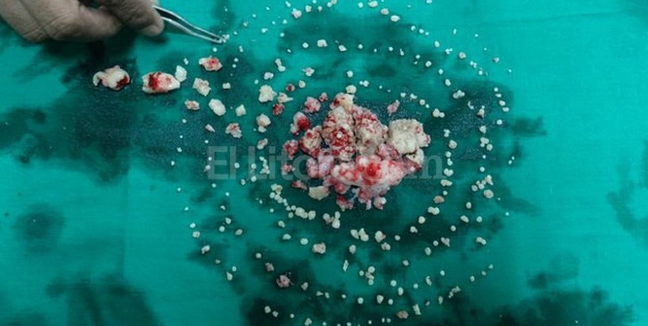 Un adolescente indio tenía 232 dientes