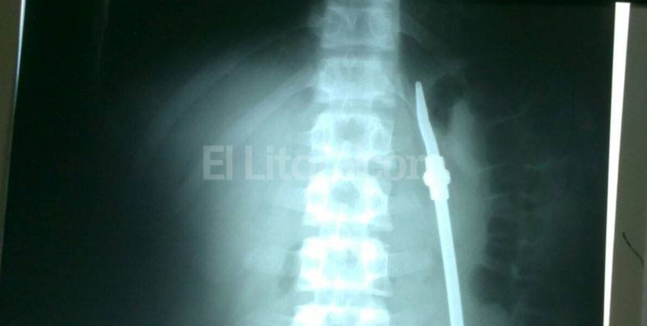 Insólito: un preso se tragó una bombilla de mate y fue intervenido quirúrgicamente