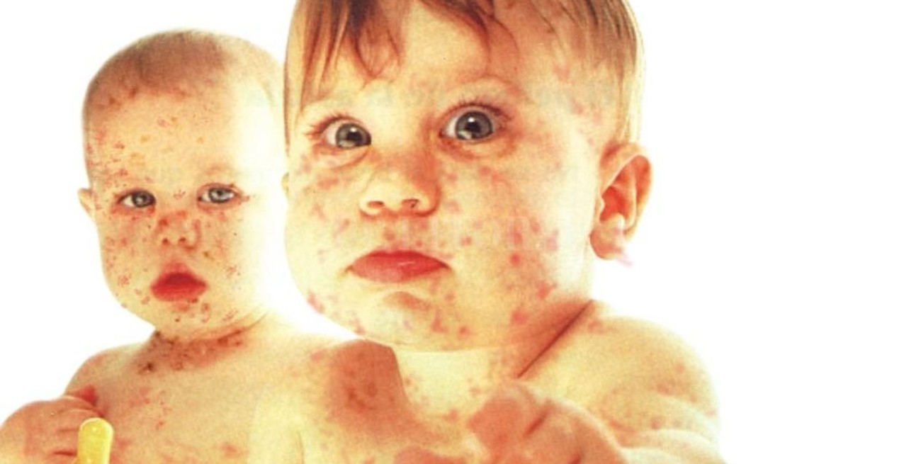 Alerta por casos de sarampión