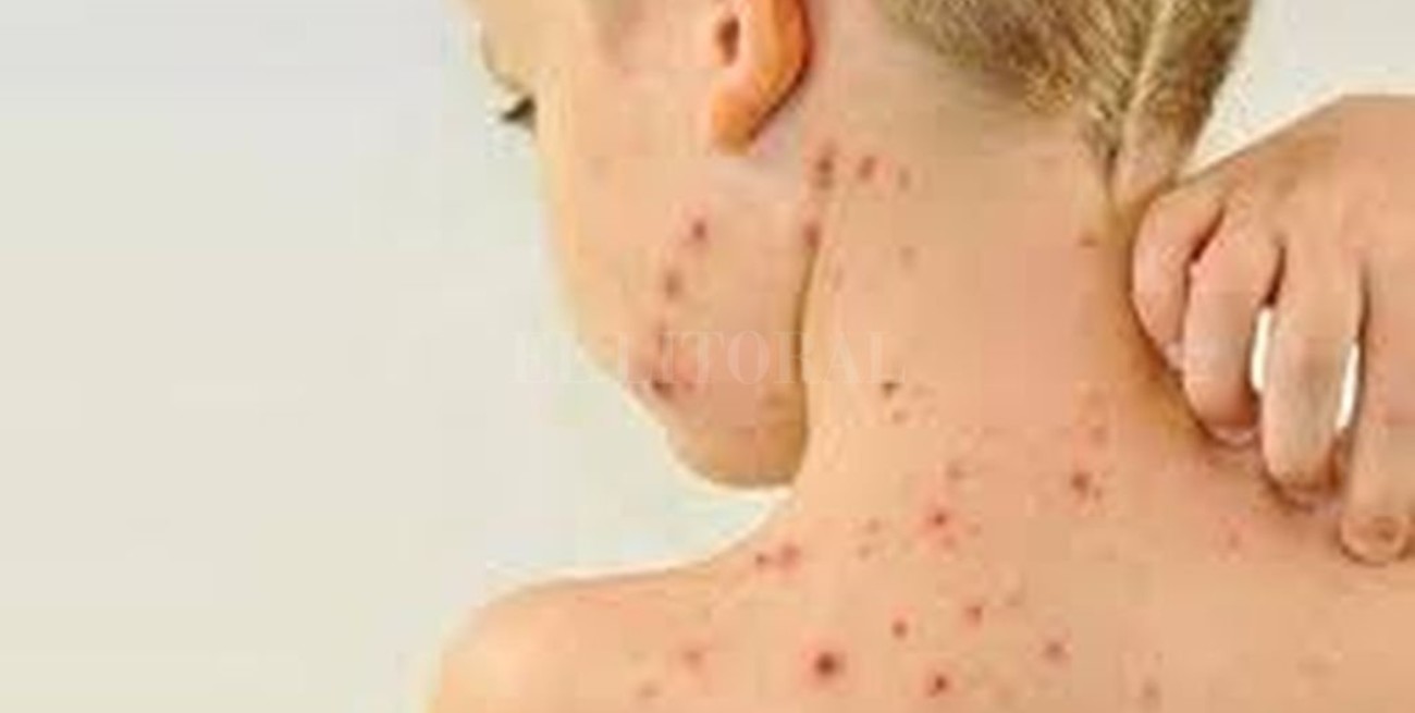 Recomiendan vacunar contra el sarampión