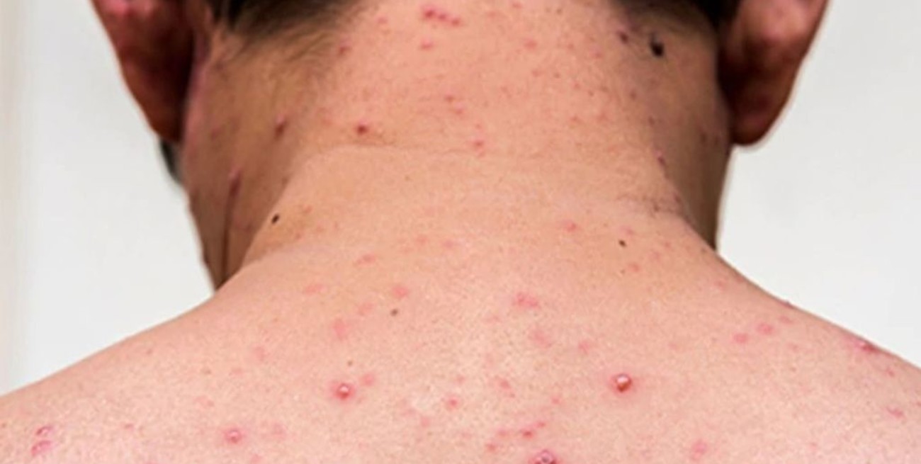 Alerta por el brote de sarampión para quienes viajen a Buenos Aires