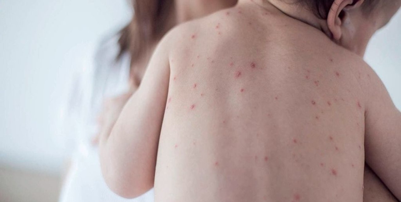 La Pampa declaró el alerta por los casos de sarampión