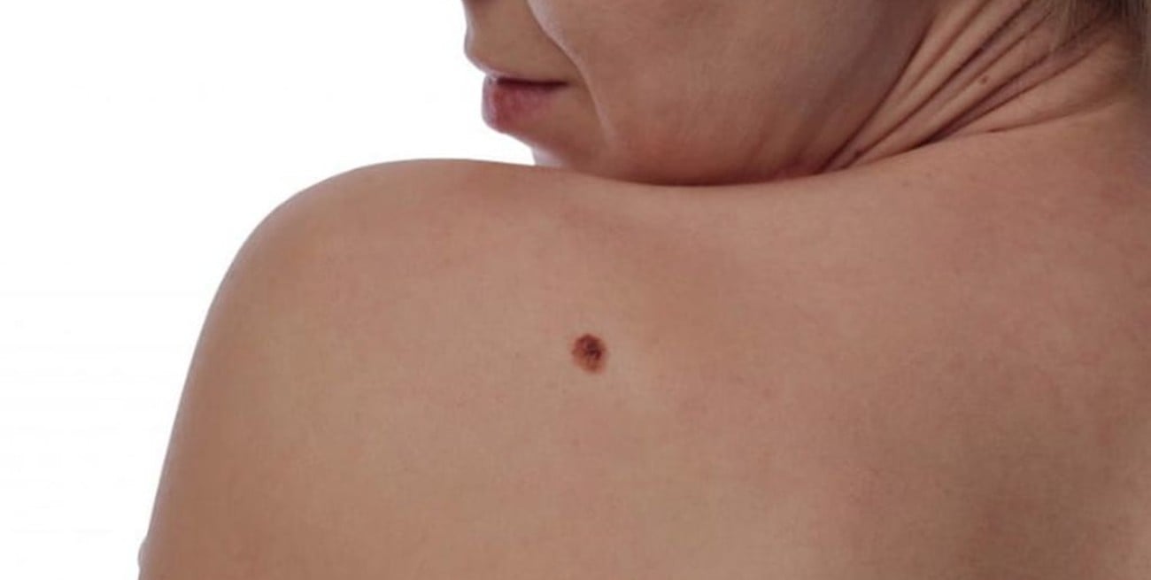 Lanzan campaña para detectar el Melanoma a tiempo, por el que mueren 550 argentinos al año