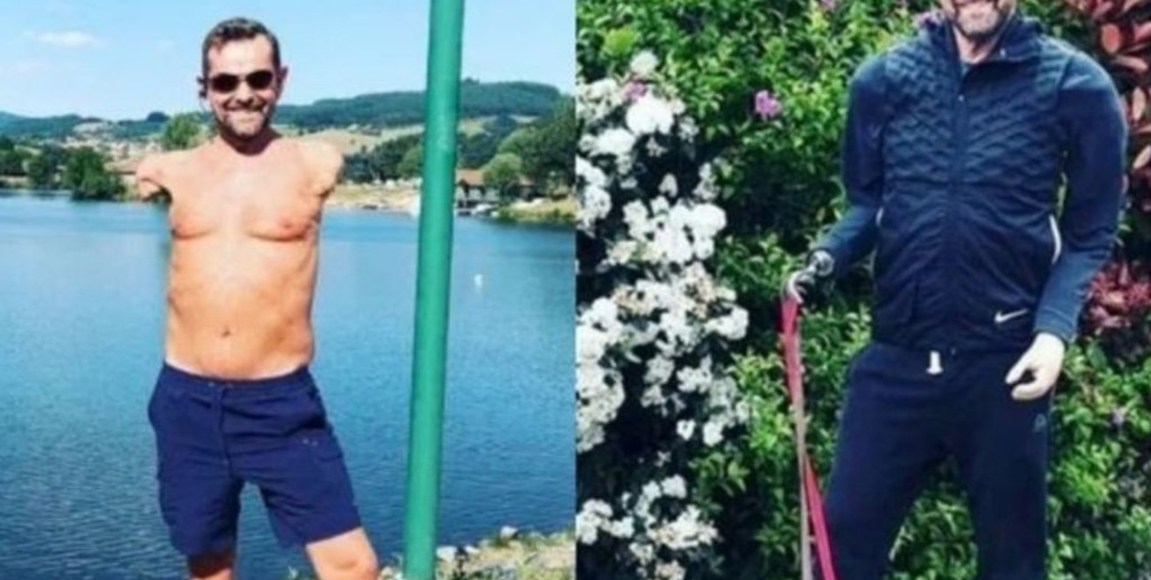 Se realizó el primer trasplante de brazos y hombros