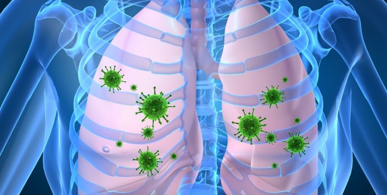 Qué es la neumonía bilateral y cómo afecta a quien la padece