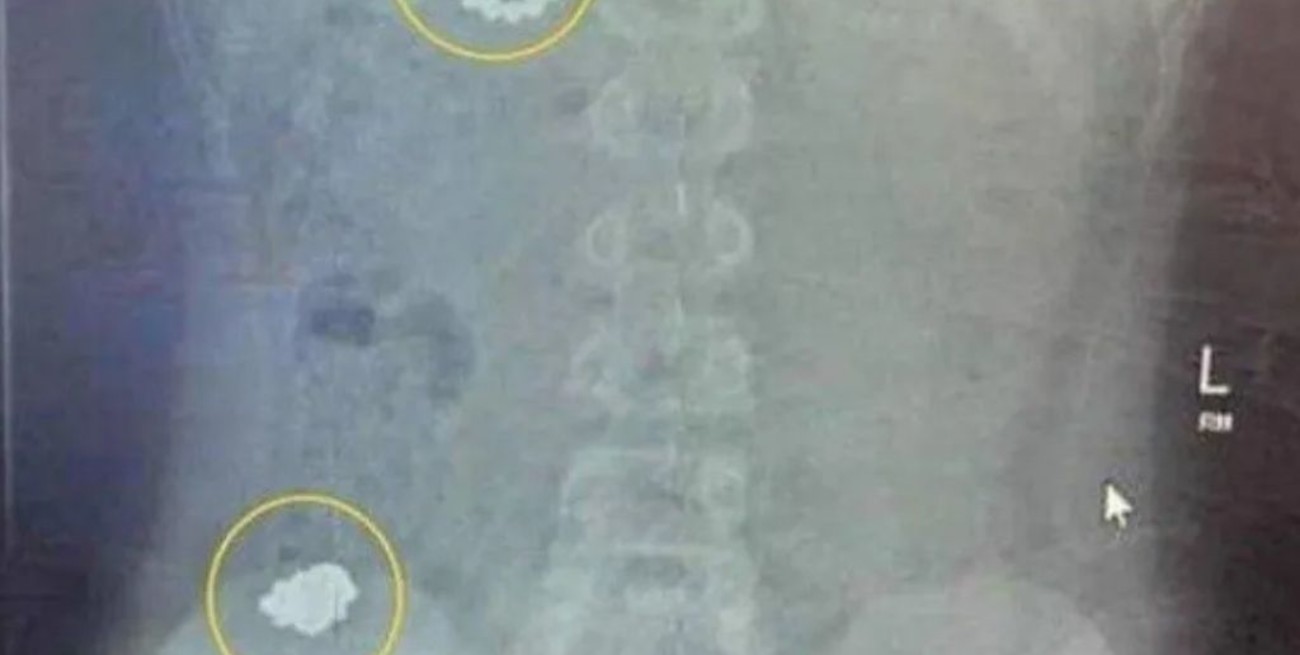 Un niño se tragó más de 50 imanes y tuvo que ser intervenido quirúrgicamente 