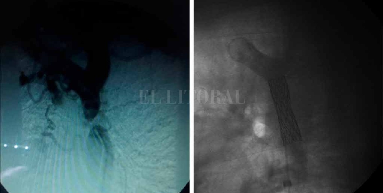 Atresia aórtica, la falla congénita que por primera vez se operó en Santa Fe