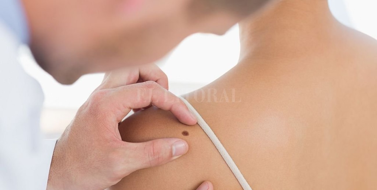 Crecieron un 20% las consultas por cáncer de piel en 2018