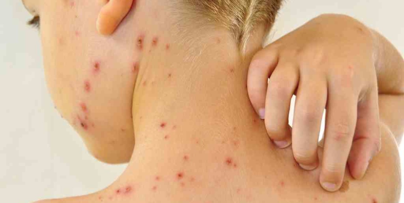 Confirmaron brotes de varicela en Paraguay