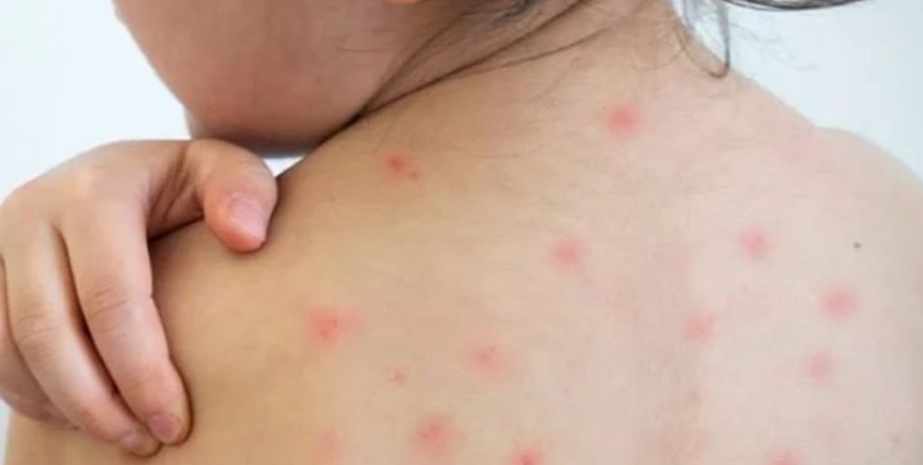 Cuatro casos de sarampión fueron confirmados en la Ciudad de México