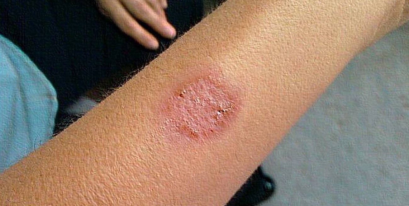 Alerta en España por casos de ántrax en humanos 