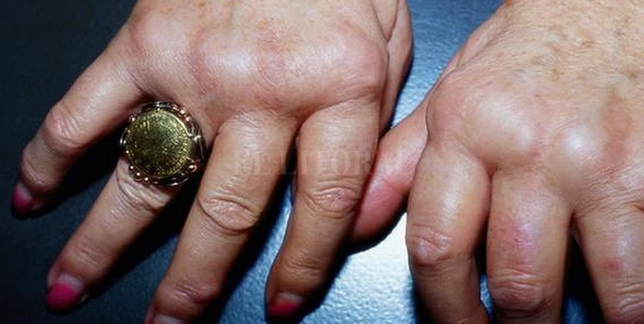 Cada vez hay más personas con enfermedades autoinmunes