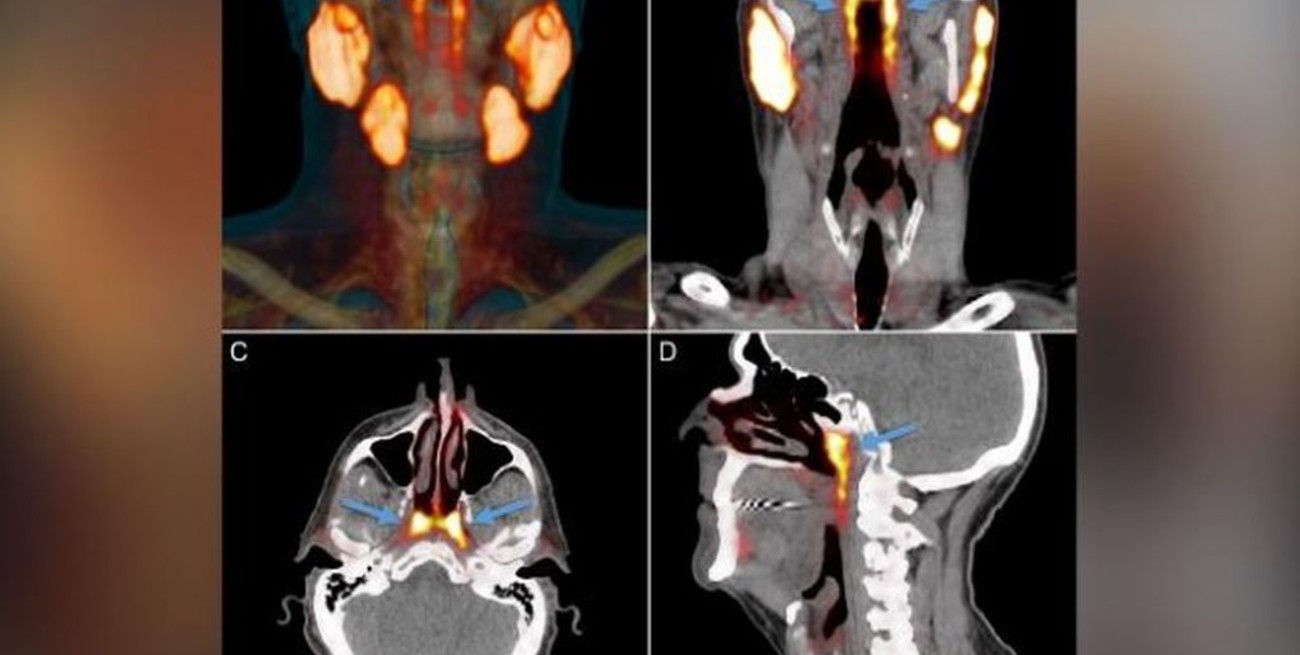 Descubren un posible "nuevo órgano" en la garganta humana
