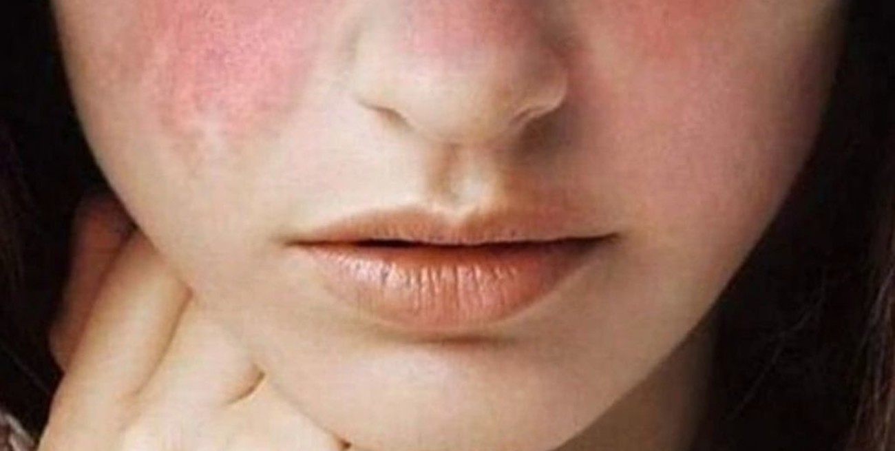 "Seamos solidarios con quienes la necesitan", piden los pacientes que usan hidroxicloroquina