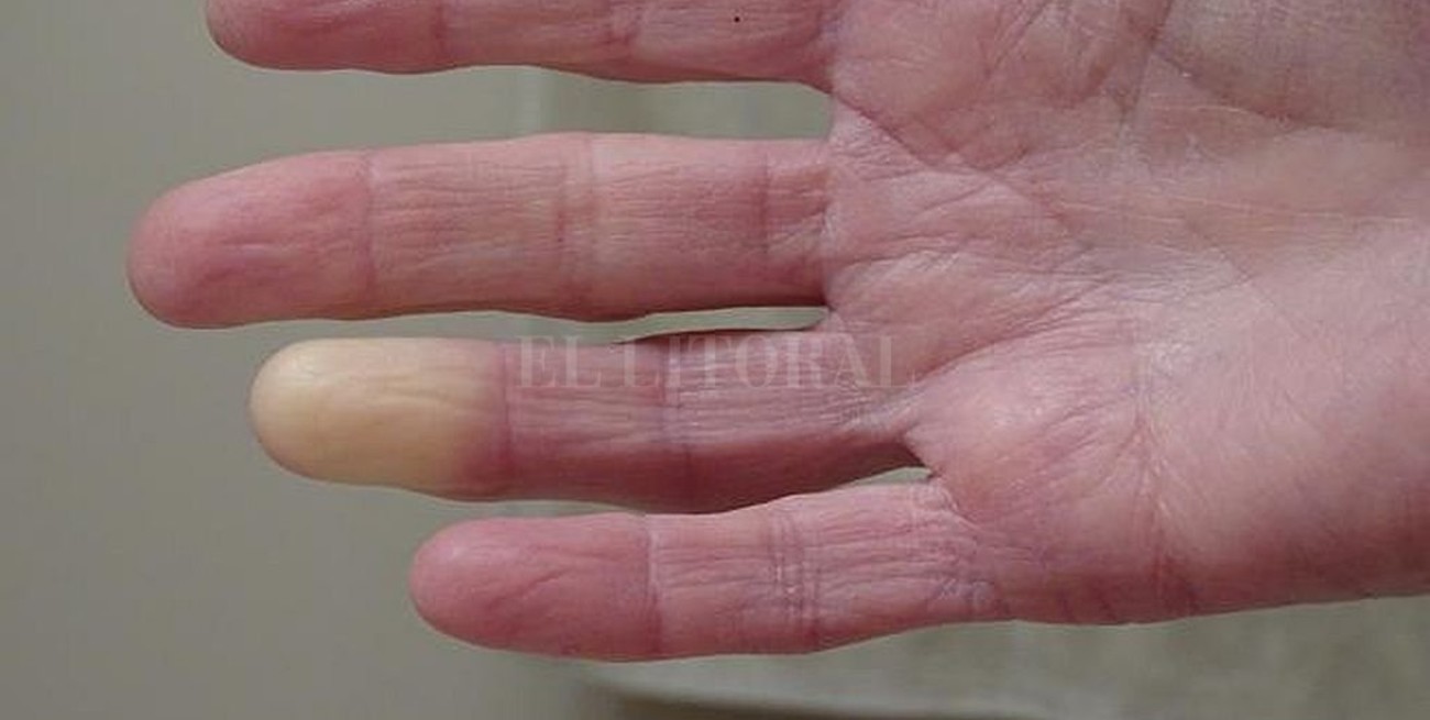 Esclerodermia: la enfermedad que "endurece" la piel